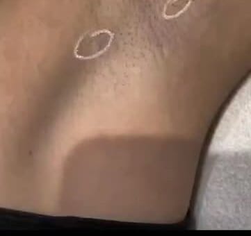 Smooth underarm skin a year and a half after laser hair removal at Aura Aesthetics
